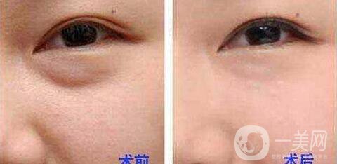 電波拉皮去眼袋*果怎么樣？