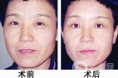 電波拉皮的功有哪些