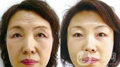 電波拉皮的功*有哪些