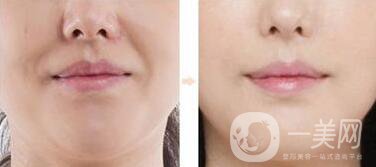 皮膚松弛法令紋熱瑪吉*果嗎