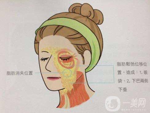 冰電波拉皮好嗎？冰電波拉皮優(yōu)勢！