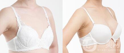 無錫假體豐胸手術(shù)多少錢啊