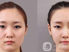 顴骨肉怎么消？怎么縮小顴骨？