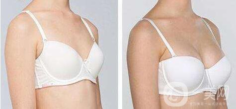 法國es假體隆胸多少錢,法國es假體隆胸價(jià)格分析
