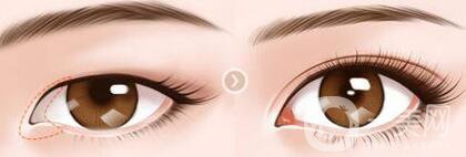 上海開(kāi)眼角價(jià)格是多少