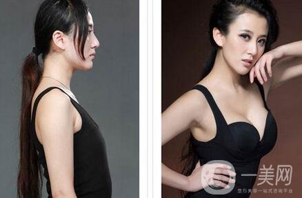 假體豐胸能大多少錢？