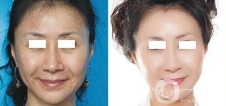 成都做個(gè)拉皮多少錢(qián)