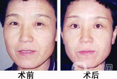 成都做個(gè)拉皮多少錢(qián)