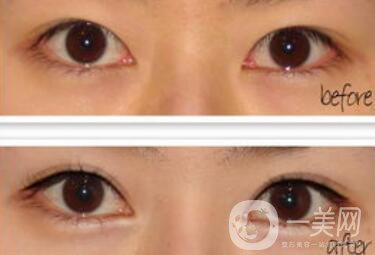 廣州開眼角的費(fèi)用是多少