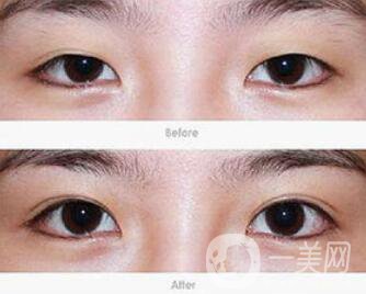 廣州開眼角的費(fèi)用是多少