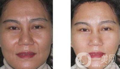 廣東電波拉皮去皺多少錢