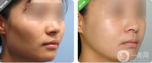 磨顴骨恢復,磨顴骨術后護理方式