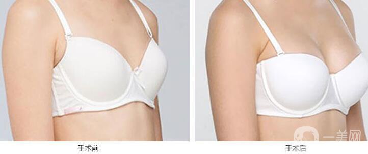 假體豐胸后什么不能吃