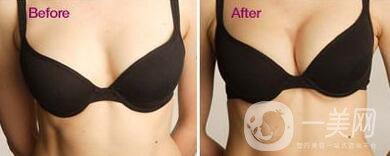 假體豐胸后什么不能吃