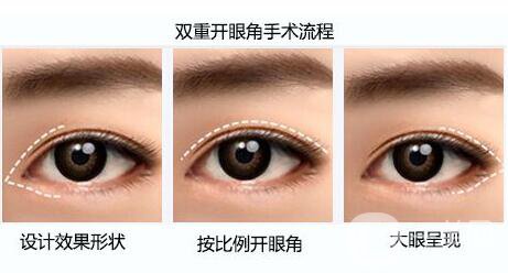 開(kāi)眼角,開(kāi)眼角多少錢(qián),開(kāi)眼角增生