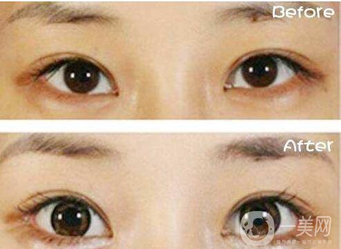 開(kāi)眼角,開(kāi)眼角多少錢(qián),開(kāi)眼角增生