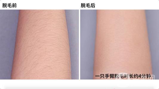 北京激光脫毛一般需要多少錢(qián) 術(shù)后怎么護(hù)理