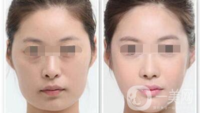 做過(guò)顴骨和下顎角手術(shù)后的感受