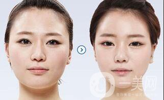 做過(guò)顴骨和下顎角手術(shù)后的感受