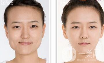 做過(guò)顴骨和下顎角手術(shù)后的感受