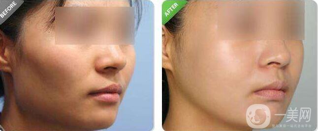 降低顴骨,降低顴骨方法,降低顴骨術后護理