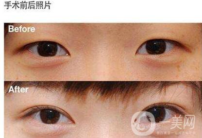 開眼角,開眼角優(yōu)勢,哪里開眼角好