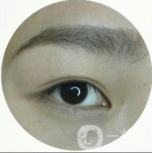 割雙眼皮手術(shù)術(shù)后疼幾天能恢復好