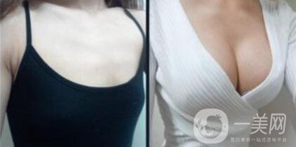 假體隆胸后感覺好嗎