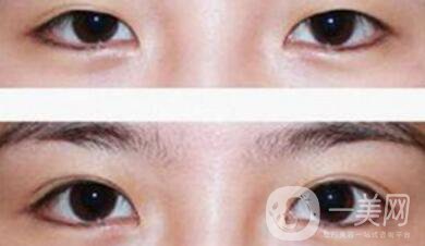 割雙眼皮為什么會成肉條