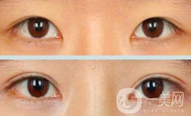 割雙眼皮為什么會成肉條