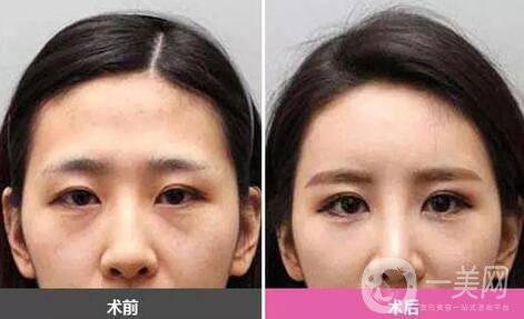 廣東自體脂肪填充淚溝多少錢？