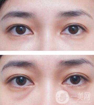 廣東自體脂肪填充淚溝多少錢？