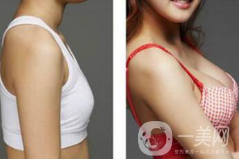 上海假體隆胸的價格高嗎？要多少錢