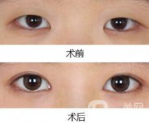 做開眼角手術前后注意事項具體是什么
