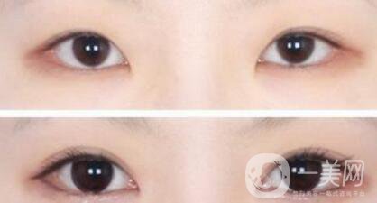 做開眼角手術(shù)前后注意事項具體是什么