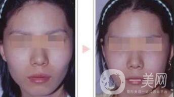 磨顴骨多久能恢復(fù) 磨顴骨價(jià)格多少