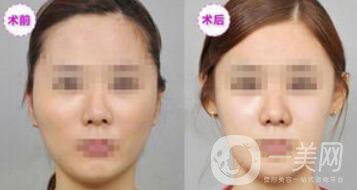 磨顴骨多久能恢復(fù) 磨顴骨價(jià)格多少