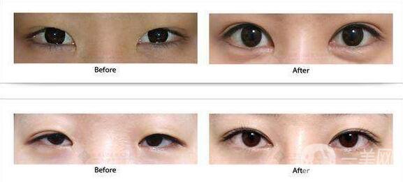 昆明割雙眼皮手術(shù)的價(jià)格一般是多少錢