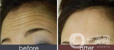 *去抬頭紋*果,*去抬頭紋*果維持多久