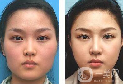 去頰脂墊瘦臉術(shù)后護(hù)理步驟