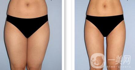 溶脂刀有什么危害 術(shù)后護理應(yīng)該怎么做