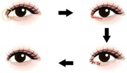 開眼角手術(shù)價(jià)格 價(jià)格影響因素分析