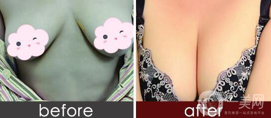 隆胸方法,隆胸多少錢