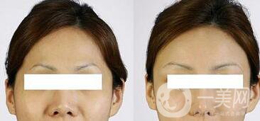 自體脂肪豐太陽穴危害有哪些