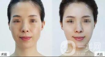 自體脂肪豐太陽穴危害有哪些