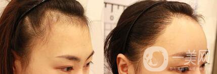 自體脂肪豐太陽穴危害有哪些