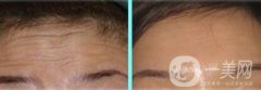 玻尿酸去抬頭紋打幾支才*果
