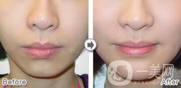 自體脂肪墊下巴術(shù)后護(hù)理注意事項(xiàng)有哪些