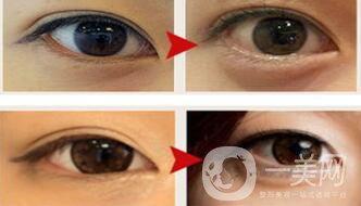 玻尿酸豐臥蠶術(shù)后護理怎么做