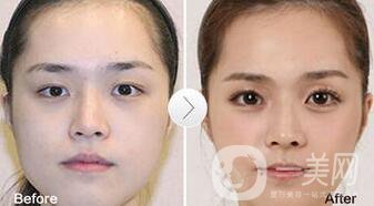 玻尿酸豐臥蠶術(shù)后護理怎么做